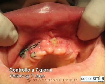 Használata dióda lézerek fogászati ​​járóbeteg sebészeti fogászat -