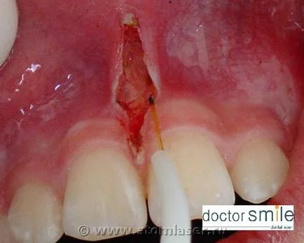 Utilizarea de diode laser în Stomatologie chirurgicală ambulatoriu dentare -