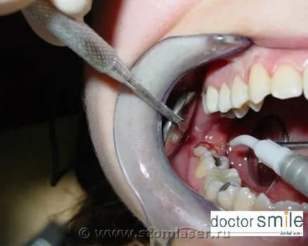 Utilizarea de diode laser în Stomatologie chirurgicală ambulatoriu dentare -