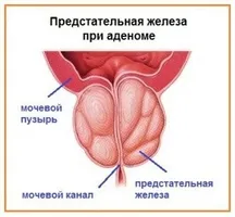 Mai sigur de a trata prostatite cele mai bune practici