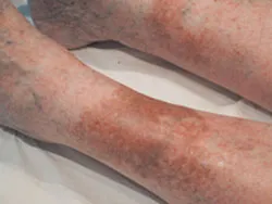 Cât de periculos vene varicoase pe picioare