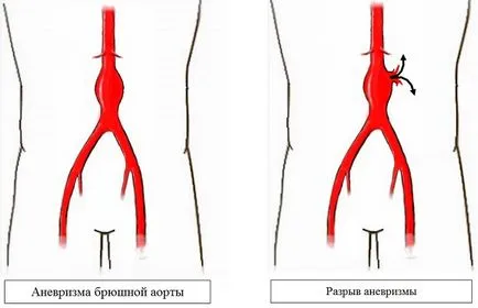 Аневризма коремната аорта