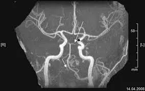 Aplasia a posterior kommunikáló artéria