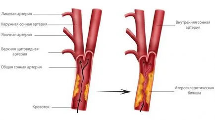 Ateroscleroza arterelor brachiocefalic - simptome si tratament