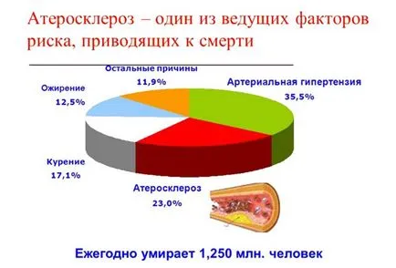 Атеросклерозата на екстракраниални отдели brachiocephalic артерия (ВСА) - стеноза, стеноза,