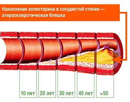 Атеросклерозата на екстракраниални отдели brachiocephalic артерия (ВСА) - стеноза, стеноза,