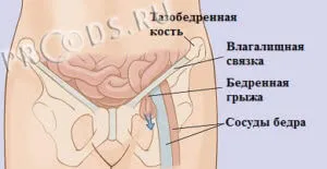 simptome hernie femurală, diagnostic, tratament