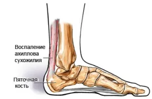 Achillodynia - симптоми и лечение на болестта