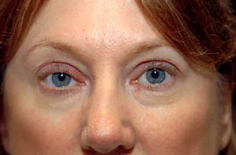 Blepharoplasty е възможността от усложнения и неуспешни случаи