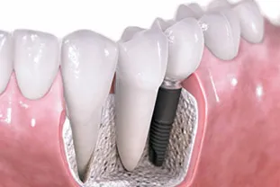 Központ modern implantátum fogászat és g