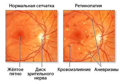 Какво е опасно за хипертония на