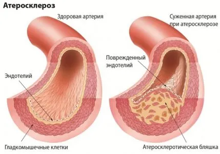 Церебрална артериосклероза какво е, продължителността на живота, симптоми