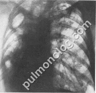 Caracterizarea radiologică a tuberculozei pulmonare fibro-cavernoasă