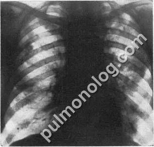 Радиационна характеристика на фибро-кавернозен белодробна туберкулоза