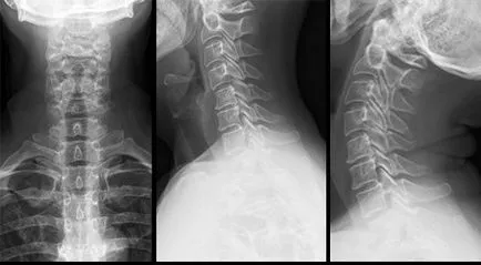 Razele X ale coloanei cervicale