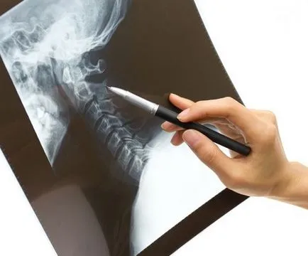 Рентгенови лъчи на шийните прешлени, който показва и обучение