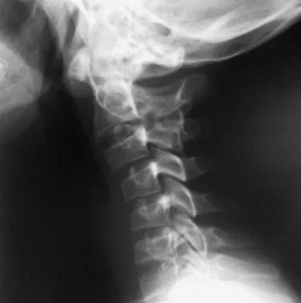 X-sugarak a nyaki gerinc