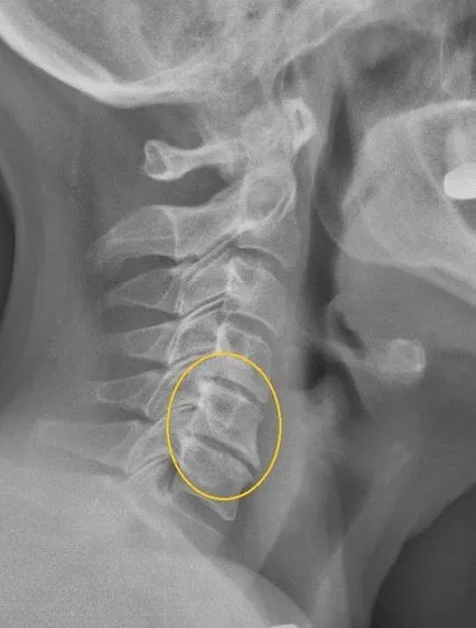 X-sugarak a nyaki gerinc, amely megmutatja és képzés
