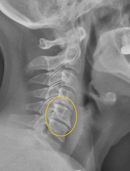 Razele X ale coloanei cervicale care arată și formarea