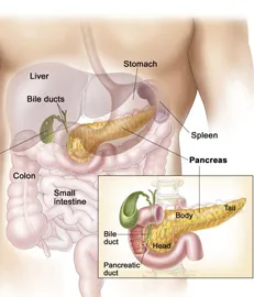 Difuz lipomatoză pancreatic 1, 2 grade fibrolipomatoz, lipom - adică, tratamentul