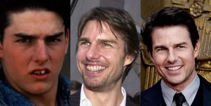 Ezek a hírességek megmutatja, hogyan kell radikálisan változtatni a fogszabályozó mosoly - hírek blog nagy