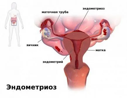 endometriózis és uterin fibroidok tünetek és a kezelés
