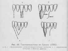 Gingivoplastie, paradontozei și periodontita, tratamentul bolilor parodontale