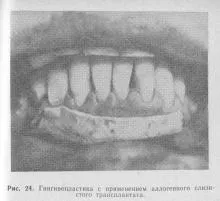 Gingivoplasty, пародонтоза и периодонтит, лечение на периодонтални заболявания