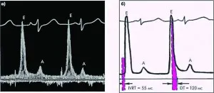 cardiopatiei