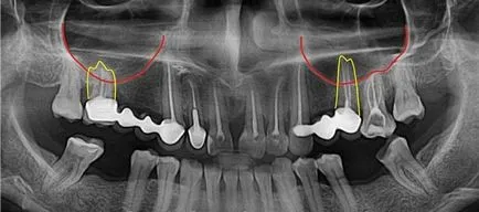 sinusurilor maxilare și dinți ce să facă în cazul în care o rădăcină dinte în sânul înțelepciunii