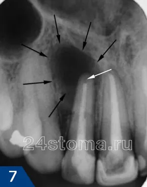 fogat granuloma - kezelés, fotó, antibiotikumok, az x-ray