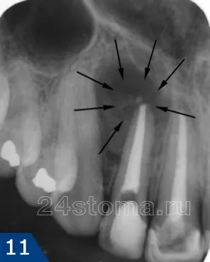 fogat granuloma - kezelés, fotó, antibiotikumok, az x-ray