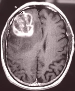 Glioblastoma agy okoz, tünetei, kezelése, a fejbőr egészségének