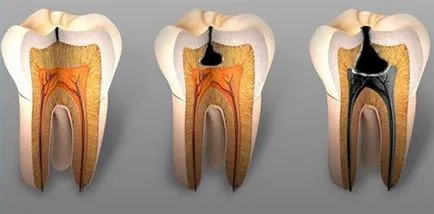 Gennyes pulpitis - tünetek, okok, kezelés