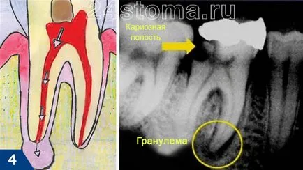 granulom dinte - tratament, fotografie, antibiotice, pe X-ray