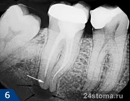 granulom dinte - tratament, fotografie, antibiotice, pe X-ray