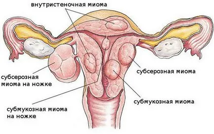 nod miom Nascent ca o complicație a fibroamelor submucoase - Simptome si tratament