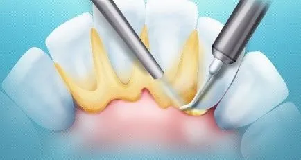 Cum sa scapi de tartru o dată pentru totdeauna tratamentul și prevenirea