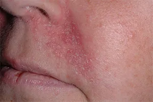 Hogyan kell kezelni a seborrhoeás dermatitis, az egészség és szépség