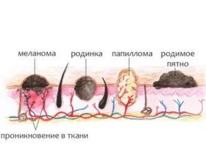 Как да се разграничи мол на папилома