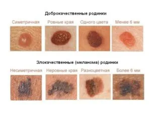 Hogyan lehet megkülönböztetni mol papilloma