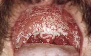 Orális candidiasis fotó, tünetei, kezelése gomba, diéta