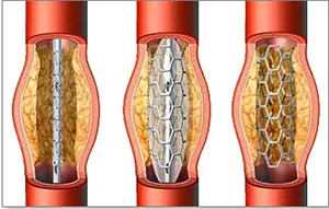 Cardiologie Stent - tratamentul inimii