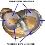 Нематода на менискуса на коляното (ganglievaya и parameniskovaya)