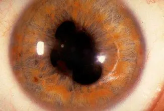 Coloboma și ochi heterophthalmia parțiale, sectoriale, centrale, oameni