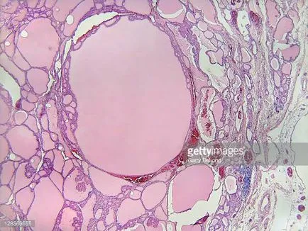 nod tiroidiană coloidal ce este, pro shchitovidku