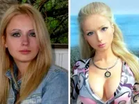 Secretele rinoplastie Lizy Boyarskoy fotografie înainte și după operație 1