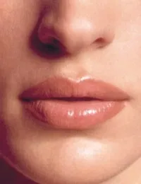 Corectarea conturului buzelor, corectarea asimetriei și întinerire a buzelor, marirea buzelor