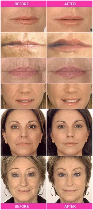 Корекция на контура на устните, коригиране на асиметрия и подмладяване на устните, увеличаване на устните