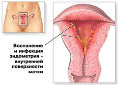 Metode de tratare a endometriozei din plante și rețete